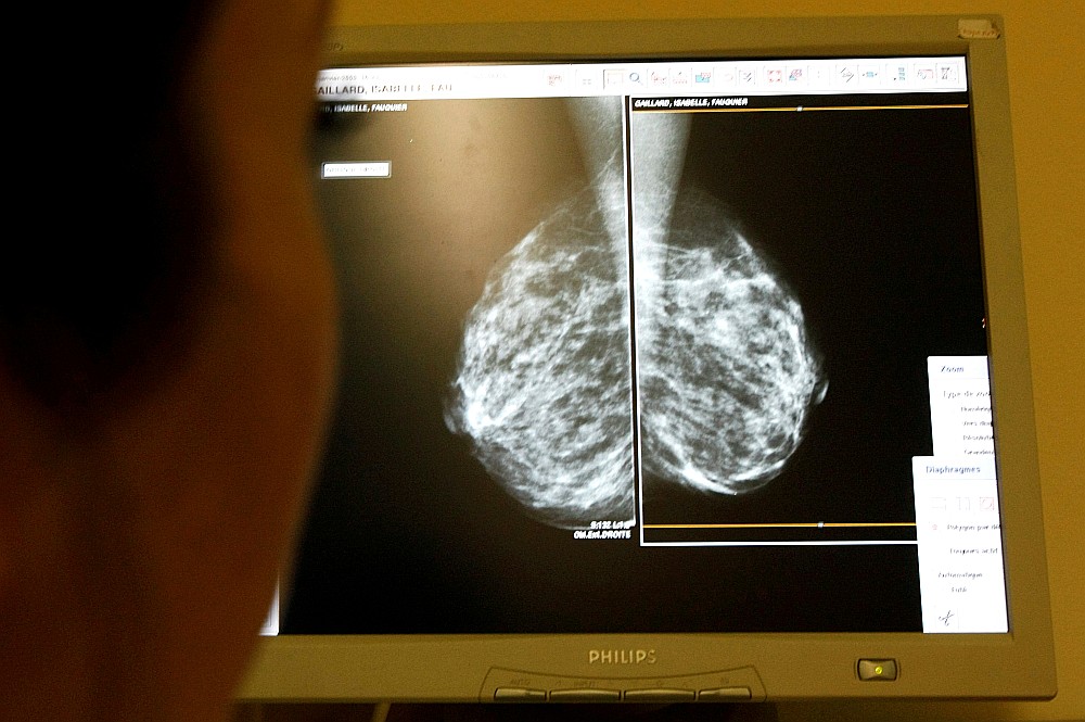 Ne visās 27 Latvijas ārstniecības iestādēs, ar kurām Nacionālajām veselības dienestam ir līgums par valsts apmaksāto krūts audzēju agrīnas diagnostikas skrīninga pakalpojumu, ir mamogrāfi, kuri spēj dot kvalitatīvu attēlu.