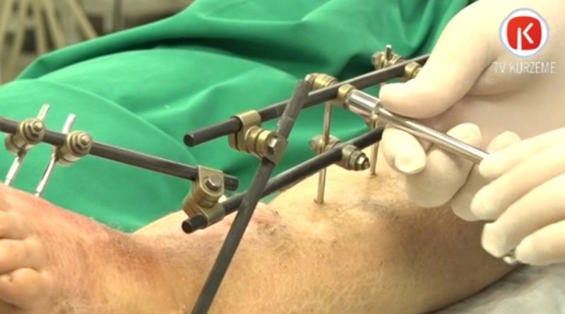 Ar mediķa Gavrila Abramoviča Ilizarova patentēto Ilizarova aparātu Liepājas Reģionālajā slimnīcā glābj 50 gadus vecas pacientes kāju no amputācijas.