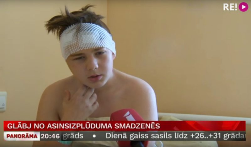 Daniels (13) pēc smadzeņu operācijas, kuras laikā no viņa galvas tika izgriezts apmēram centimetru liels veidojums.